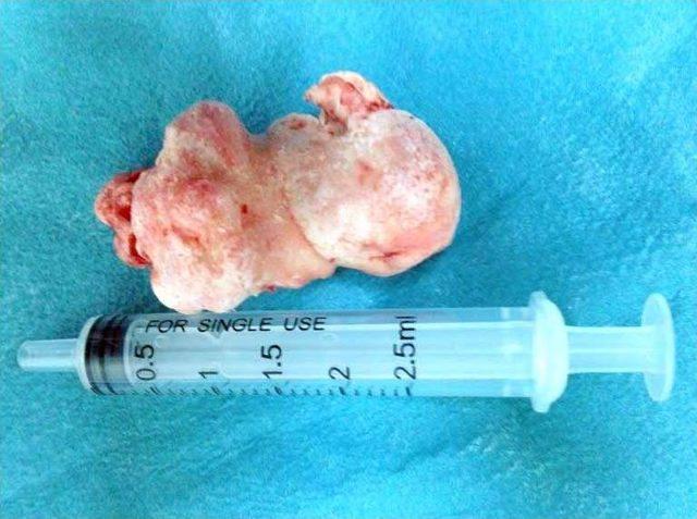 Burun Kanalından Ceviz B&uuml;y&uuml;kl&uuml;ğ&uuml;nde T&uuml;m&ouml;r &Ccedil;ıktı 1