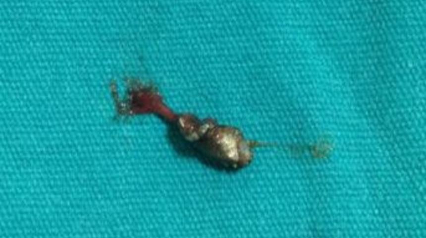 Polis Vurdu Denildi, V&uuml;cutlarında El Yapımı Bombanın Şarapnel Par&ccedil;aları &Ccedil;ıktı