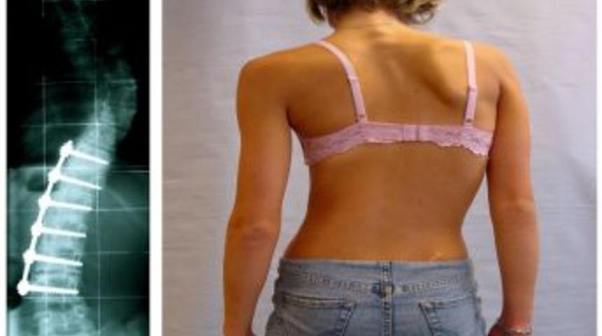 &Ccedil;ocuğunuzun ''kambur'' Olmasını İstemiyorsanız ''duruş Bozukluğunu'' Dikkate Alın