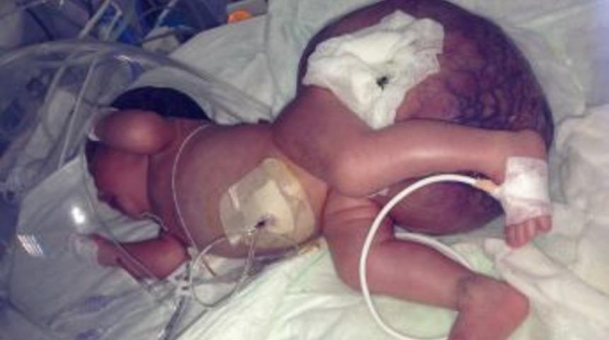 4 Kilo Doğan Bebekten 2 Kiloluk Kitle Alındı