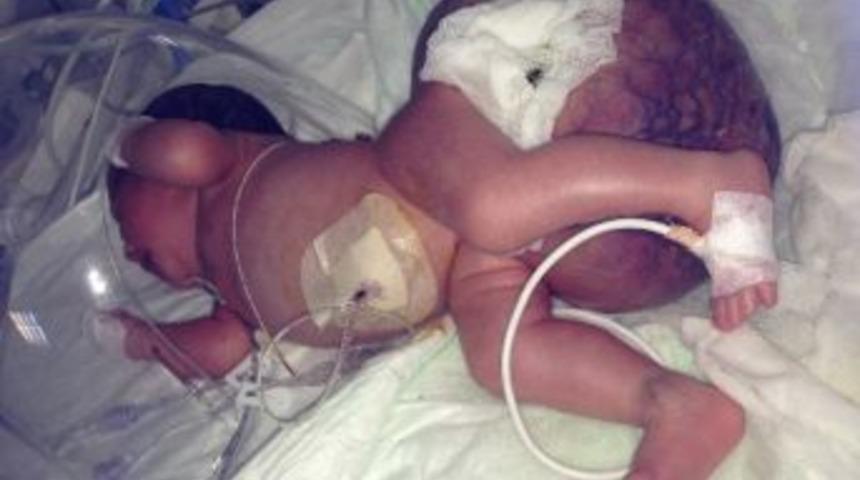 V&uuml;cudundaki İki Kilo Kitle İle Hayata Tutundu