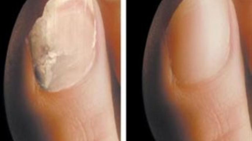 ''mantar'' Mevsimi Geldi, Tırnaklarınızı Koruyun