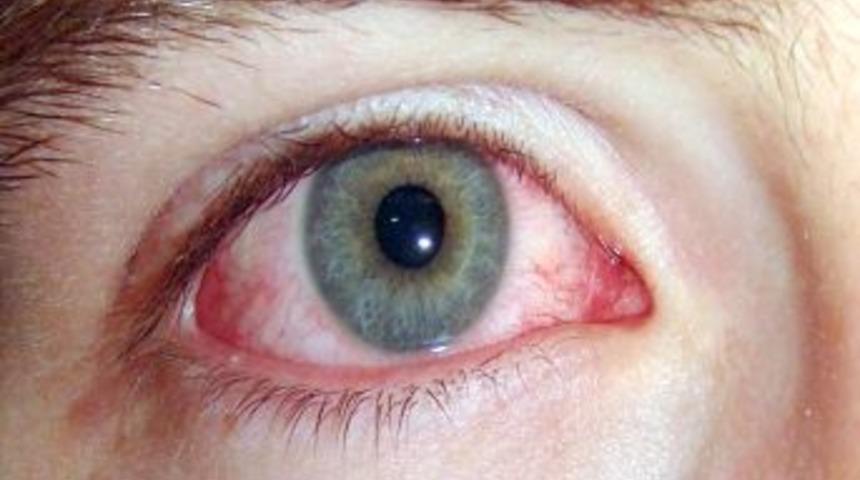 Uzmanlardan Bulaşıcı Hastalık Uyarısı: Elinizi G&ouml;z&uuml;n&uuml;ze S&uuml;rmeyin!