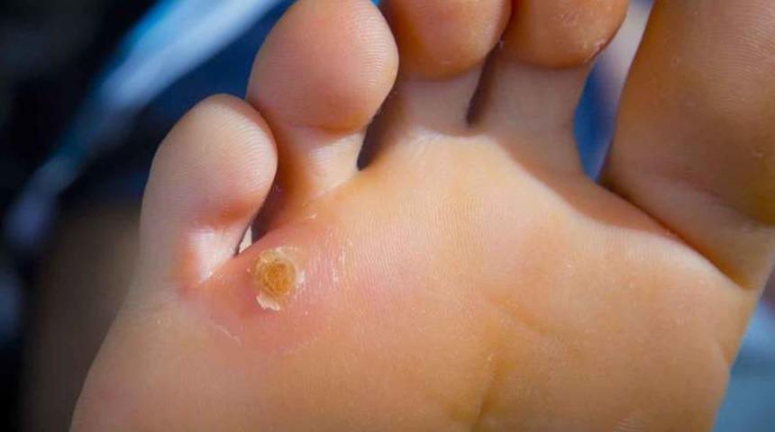 Nasır probleminden tamamen kurtaracak doğal yöntem