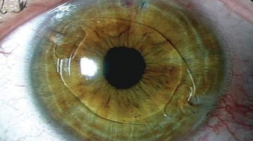 23 Yıllık G&ouml;zl&uuml;k Esaretinden Bir G&uuml;nde Kurtuldu