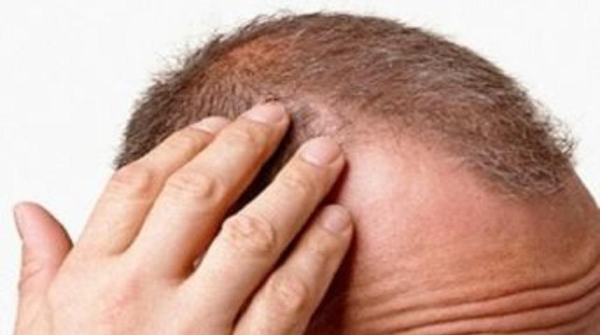Troid Hastalıkları &Ouml;nce Sa&ccedil;ı Vuruyor