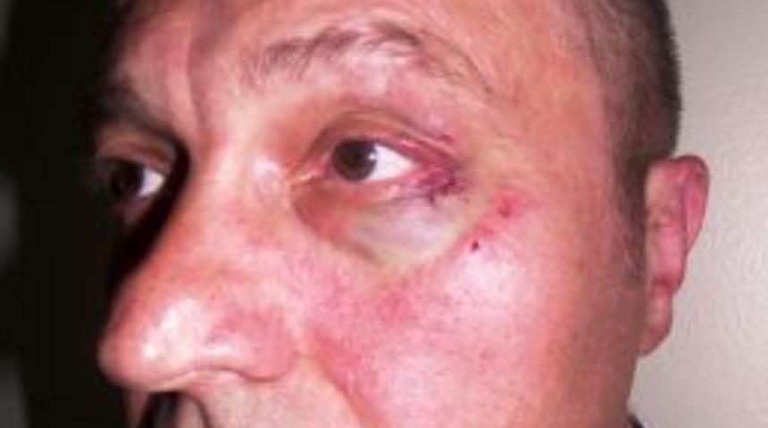 &Ccedil;ocuğuna Biyopsi Yapılmamasına Kızan Baba, Doktoru Darp Etti