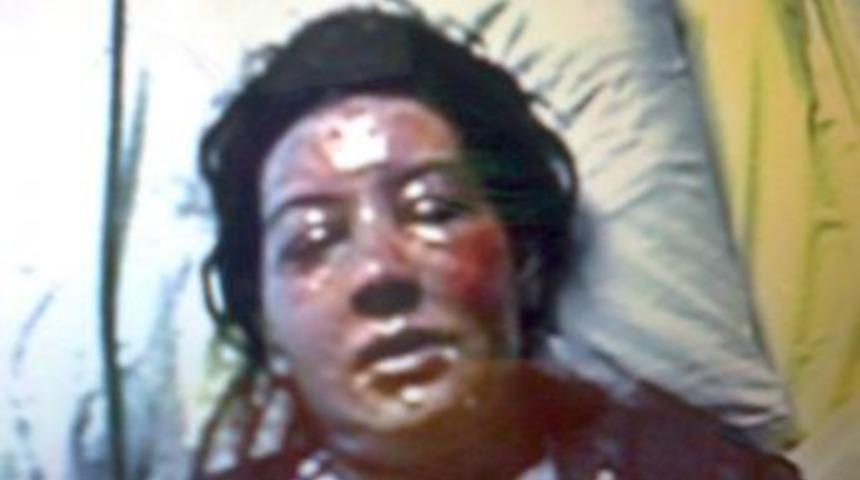 İlk Eşi Darp Etti Ve Annesini Bı&ccedil;akladı, Ikinci Eşi Kaynar Suyla Yaktı