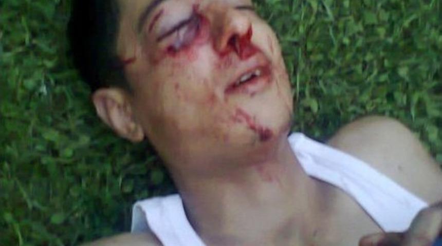 G&ouml;z&uuml;ne Biber Gazı Kaps&uuml;l&uuml; İsabet Eden Lise &Ouml;ğrencisinin Tedavisi S&uuml;r&uuml;yor