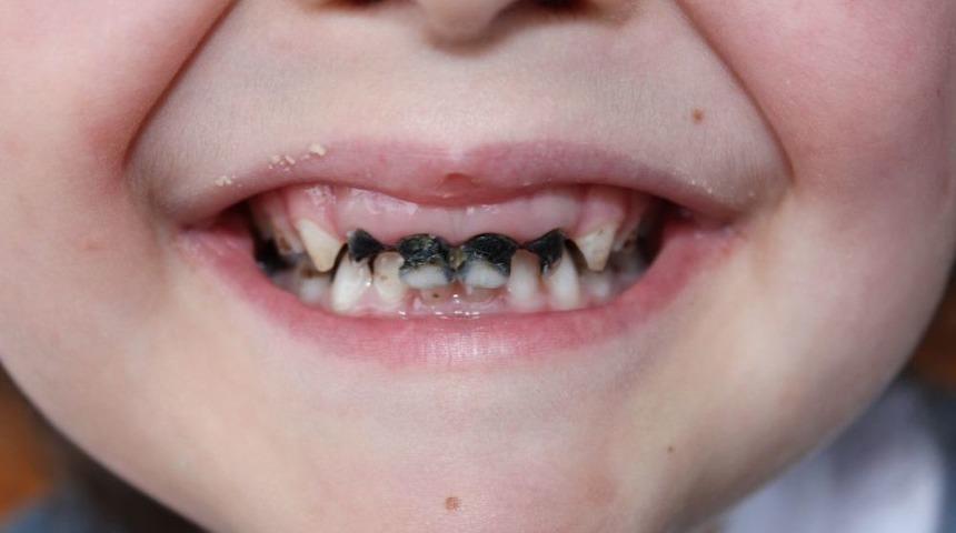 &Ccedil;ocuklarda Antibiyotik Kullanımı Diş &Ccedil;&uuml;r&uuml;mesine Neden Oluyor