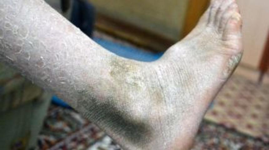 Balık Derili Kız, Sağlık Bakanı Mehmet M&uuml;ezzinoğlu'ndan Yardım Istedi