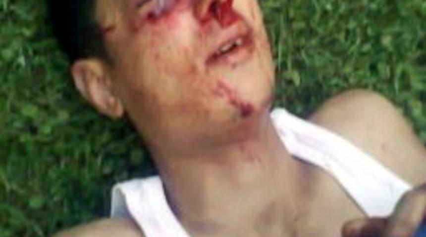 Vedat'a Protez G&ouml;z Takılacak