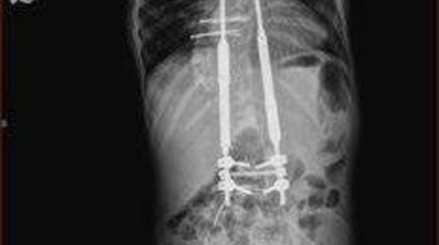 Omurga Eğriliği Hastalığına &lsquo;uzayan Platin&rsquo;le &Ccedil;&ouml;z&uuml;m