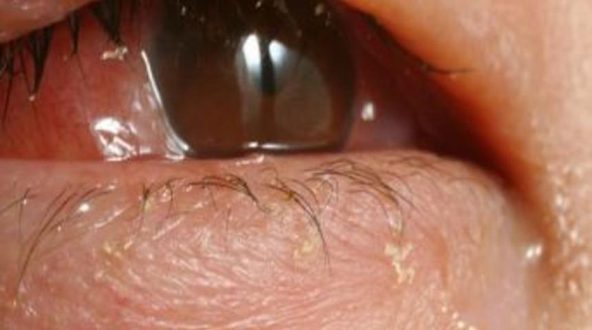 Havuz Suyu G&ouml;z Enfeksiyonlarına Neden Olabilir