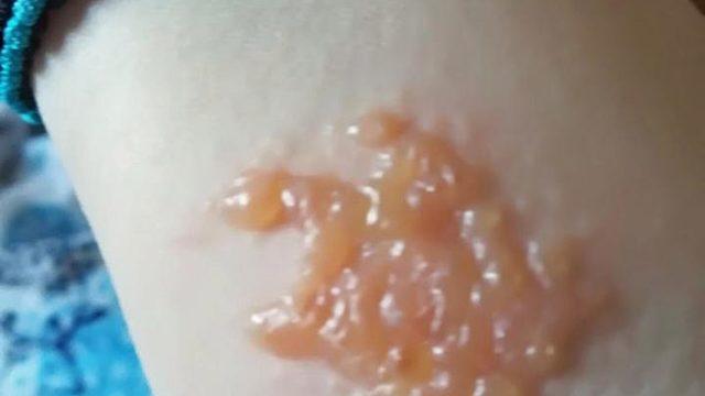 Hint kınası genç kadının hayatını kabusa çevirdi