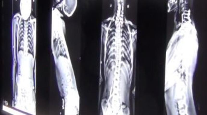 T&uuml;rk Doktorun Bulduğu Y&ouml;ntem Boyun Eğriliği Yaşayan Kas Hastalarına Umut Oldu