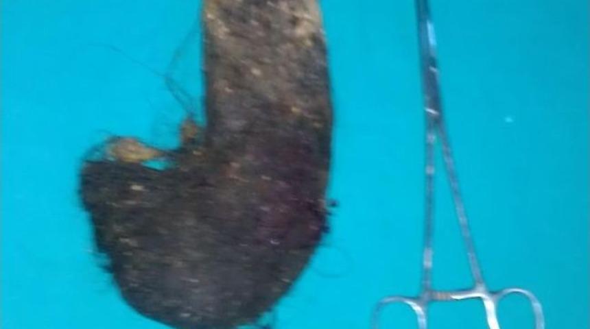 Gen&ccedil; Kızın Midesinden 1 Kilo Sa&ccedil; &Ccedil;ıktı