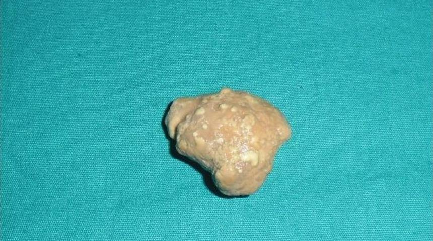 T&uuml;kr&uuml;k Bezindeki Taş Ameliyatla Alındı