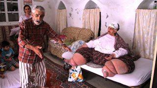 Fil hastalığı yüzünden gün ışığı görmedi