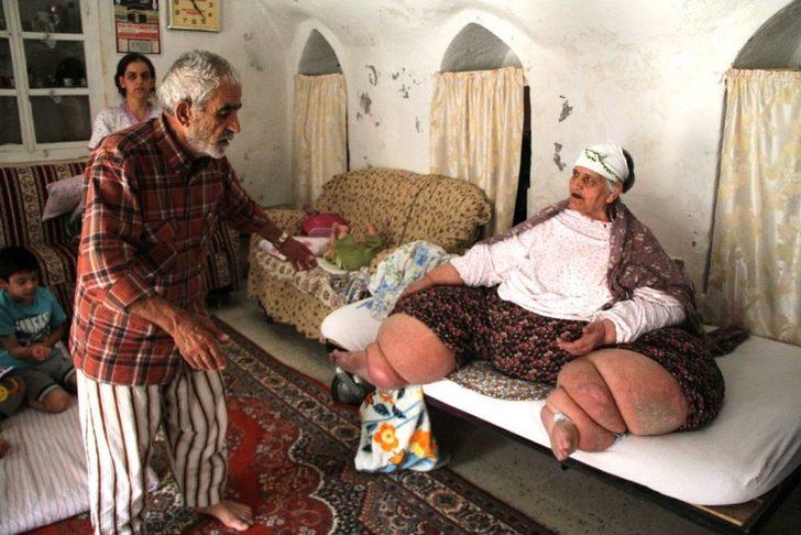 Fil hastalığı yüzünden gün ışığı görmedi G1