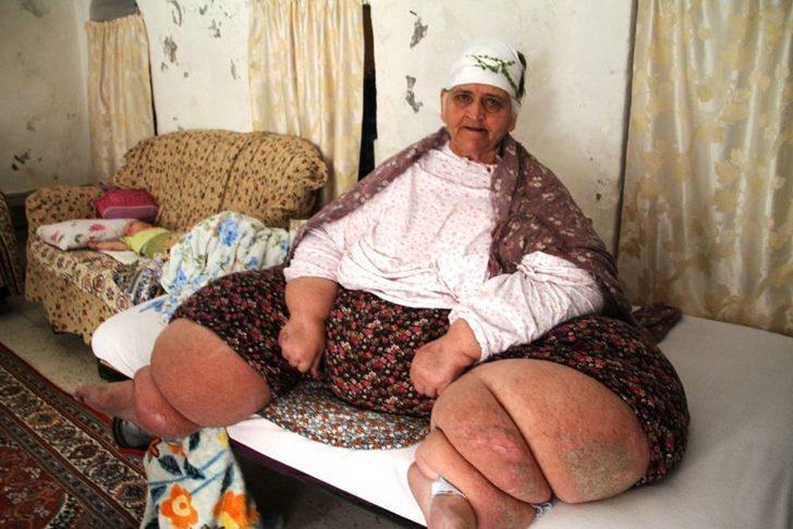 Fil hastalığı yüzünden gün ışığı görmedi G2