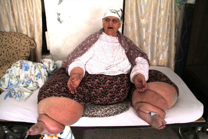 Fil hastalığı yüzünden gün ışığı görmedi G3