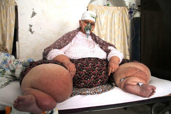 Fil hastalığı yüzünden gün ışığı görmedi G4