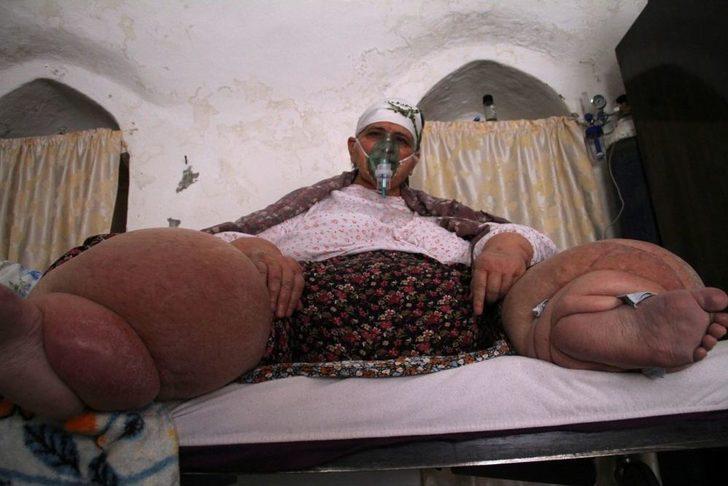 Fil hastalığı yüzünden gün ışığı görmedi G5