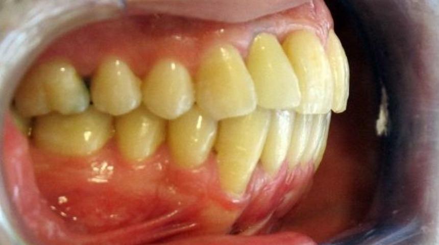 Tel Takmadan Da D&uuml;zg&uuml;n Dişlere Sahip Olunabilir