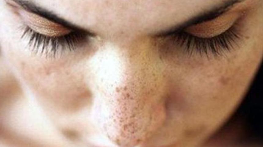 G&uuml;neş lekelerinden korunarak yazı atlatın