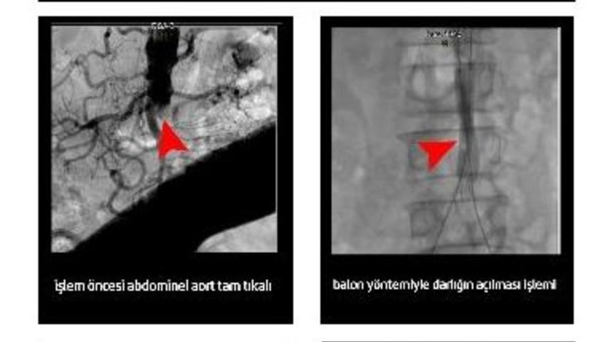 Tıkalı Aort Ve Bacak Damarları Ameliyatsız Y&ouml;ntemle A&ccedil;ıldı