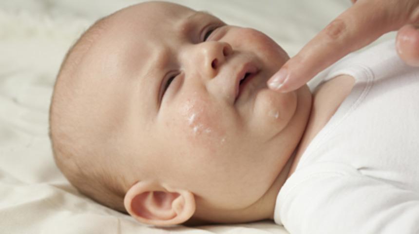 Terleme, bebeklerde egzamaya sebep olabilir!