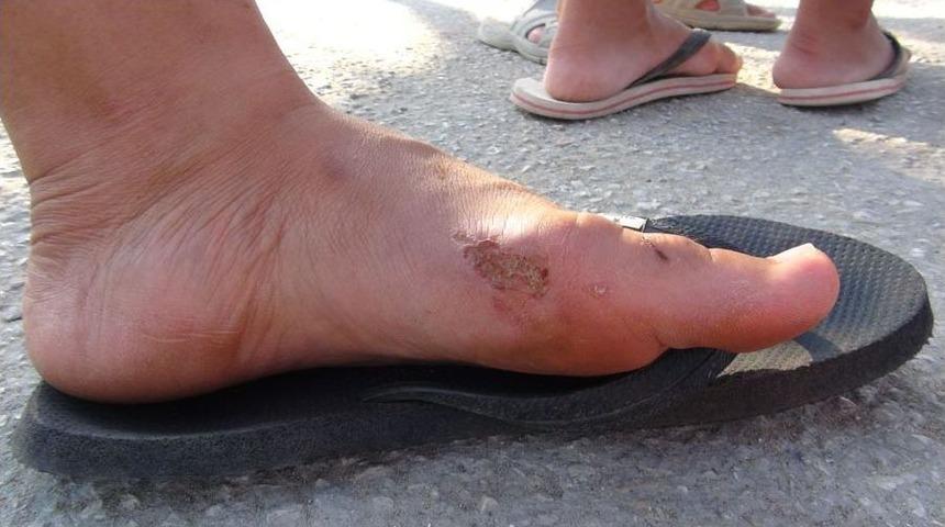 Denizde Y&uuml;zenleri Isırdığı Iddia Edilen Kaplumbağalar Inceleniyor