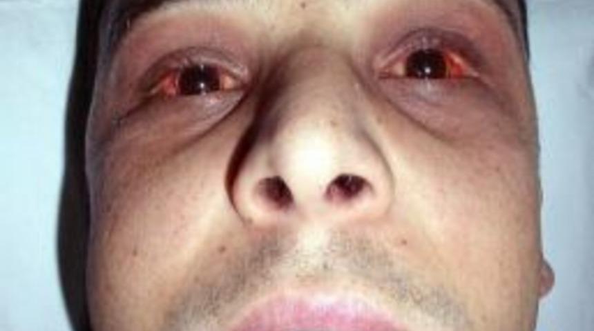 Domuz Etli &Ccedil;iğ K&ouml;fte Davası Yargıya Takıldı