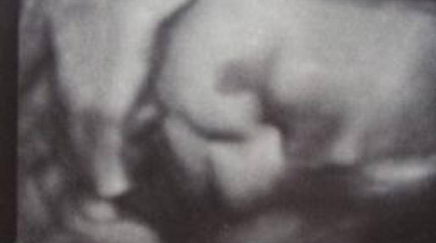 &Ouml;zel Bing&ouml;l Hastanesi, 4 Boyutlu Ultrason Hizmetini Sunmaya Başladı