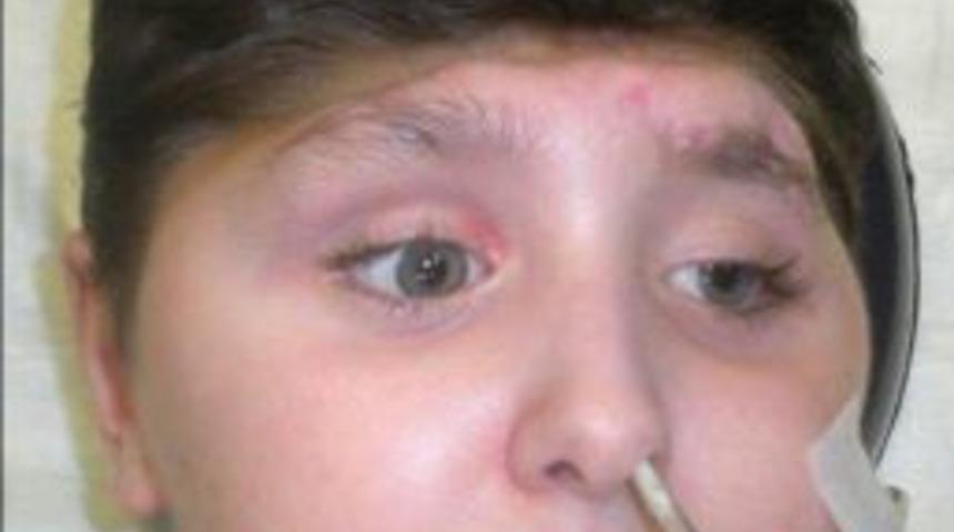 K&uuml;&ccedil;&uuml;k Emre&rsquo;ye yapay kafatası kemiği