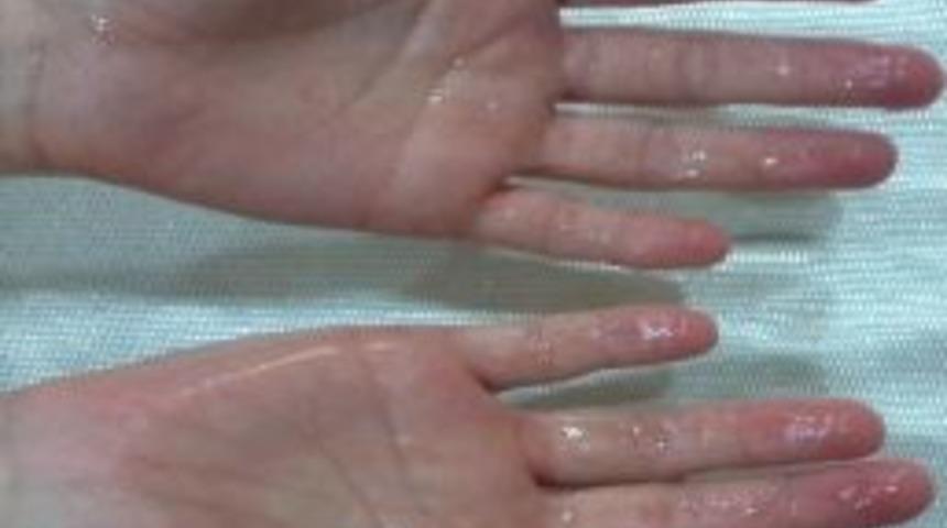 Aşırı Terleme Hastalığı