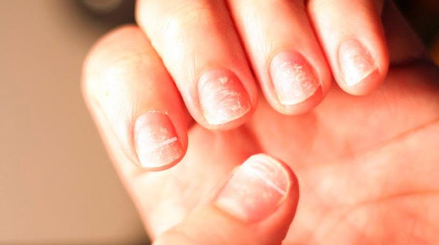 Tırnaklarınıza bakarak hastalığınızı öğrenebilirsiniz