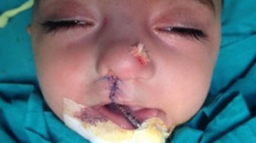 Siirt'te Yarık Dudak Ameliyatı