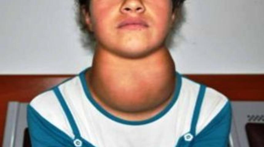 'Guatr Hastalığında Bitlis Endemik B&ouml;lge'