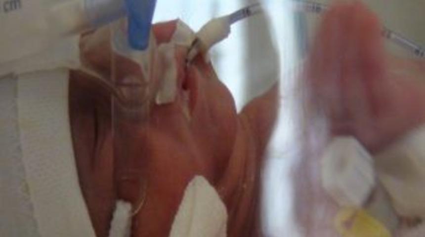 Parmak Bebek S&uuml;meyye Ameliyat Oldu