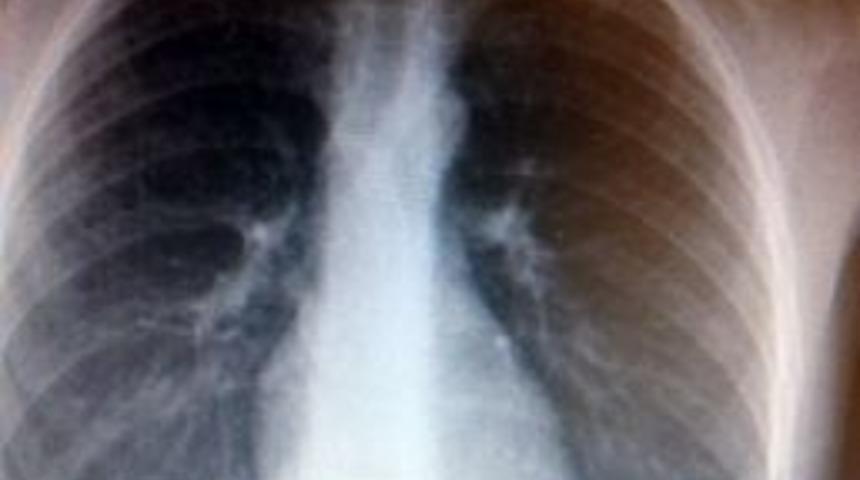 Madeni Para Yutan &Ccedil;ocuk &Ouml;l&uuml;mden D&ouml;nd&uuml;