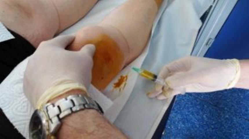 Diz Kire&ccedil;lenmesinde Yeni Umut: Prp Tedavisi