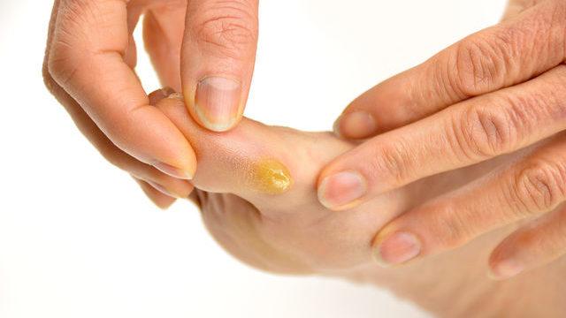 Nasıra ne iyi gelir? Acısına dayanılamayan nasır evde tedavisi var mı, doğal yollarla nasıl geçer?