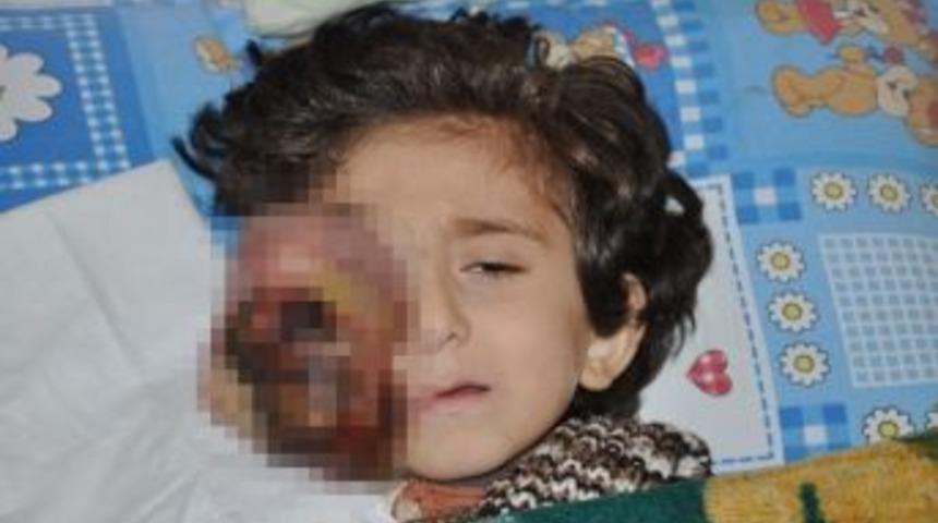 Y&uuml;z&uuml;nde Ur &Ccedil;ıkan Minik Muhammed Yardım Bekliyor