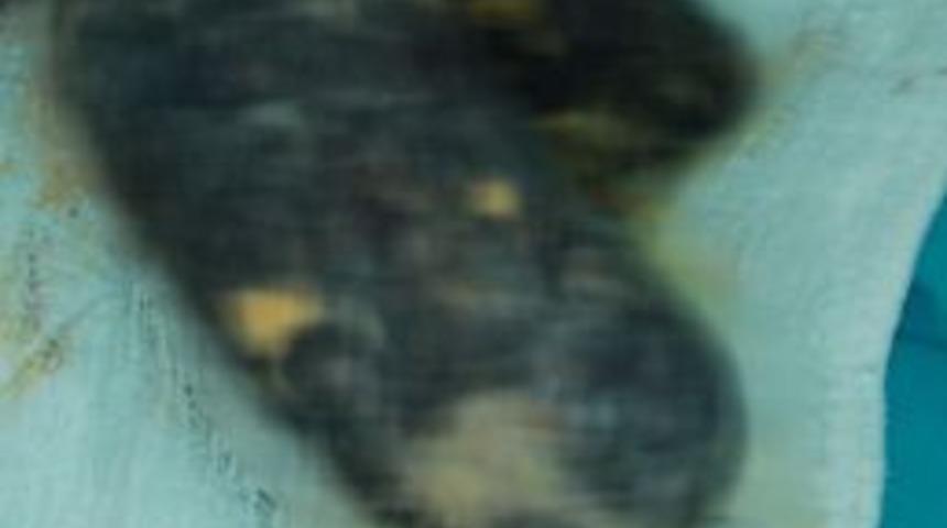 Gen&ccedil; Kızın Midesinden 2 Kilogram Kıl Yumağı &Ccedil;ıktı