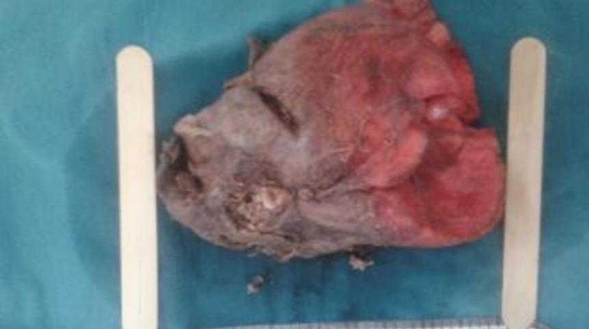 Akciğerindeki 20 Cm.'lik Kanserli Doku Ameliyatla Temizlendi