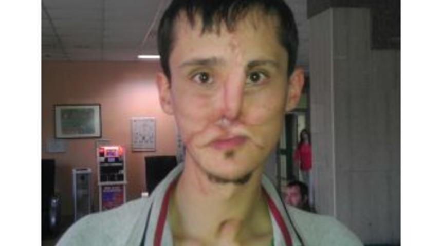 T&uuml;rkiye'nin 7'inci Y&uuml;z Nakli Yapılıyor