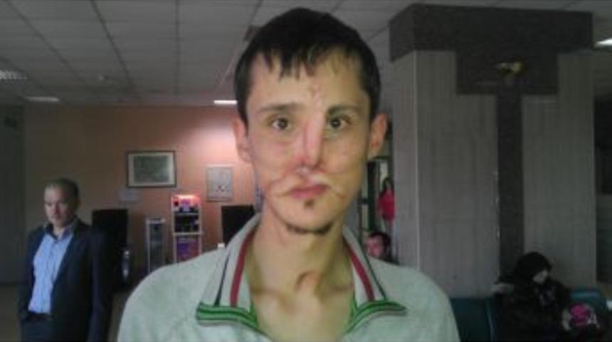 Yüz Nakli Olmak Için Yola Çıkan Recep Kaya Uçağı Kaçırınca Çok Korktu