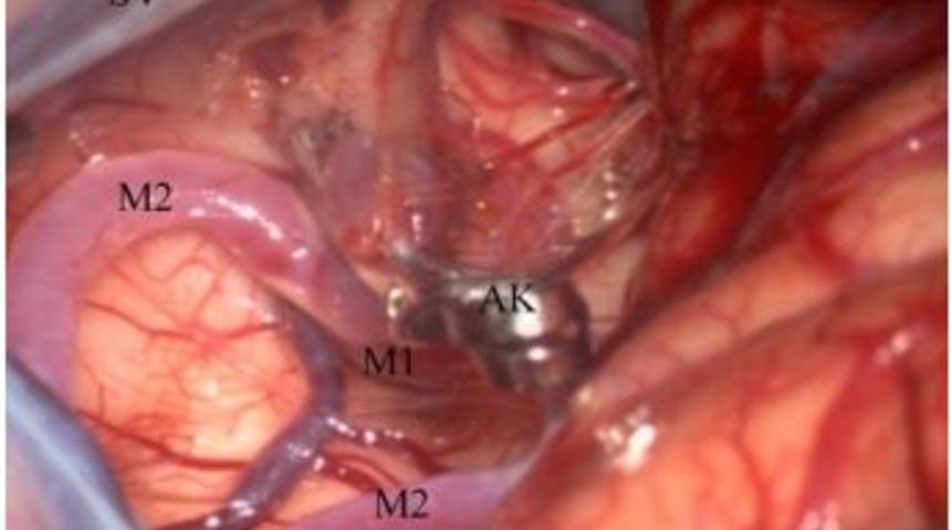 Sigara Beyin Damarlarını Bu Hale Getiriyor